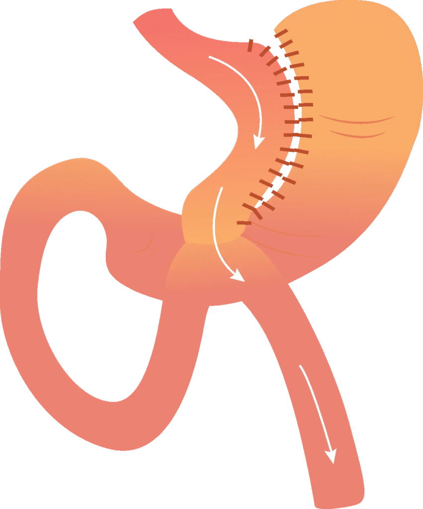 Best Bariatric Surgeon in Indore | Dr. Nikunj Jain | Apollo Hospital 3 Best Bariatric Surgeon in Indore