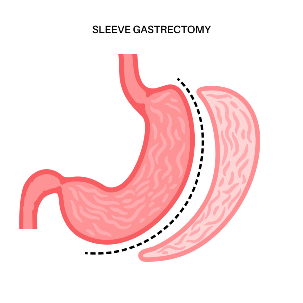 Top Gastric Sleeve Specialists in Indore | Dr. Nikunj Jain | Apollo Hospital 1 Top Gastric Sleeve Specialists in Indore