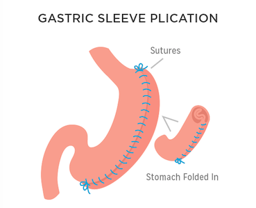 Gastric Sleeve Specialist in Indore| Dr. Nikunj Jain | Apollo Hospital Indore 1 Gastric Sleeve Specialist