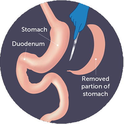 Gastric Sleeve Specialist in Indore| Dr. Nikunj Jain | Apollo Hospital Indore 2 Gastric Sleeve Specialist