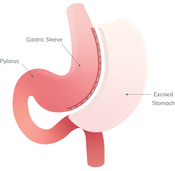 Gastric Sleeve Specialist in Indore| Dr. Nikunj Jain | Apollo Hospital Indore 3 Gastric Sleeve Specialist