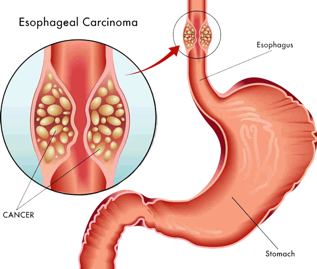Esophageal Surgery in Indore | Dr. Nikunj Jain | Apollo Hospital 4 Esophageal Surgery in Indore
