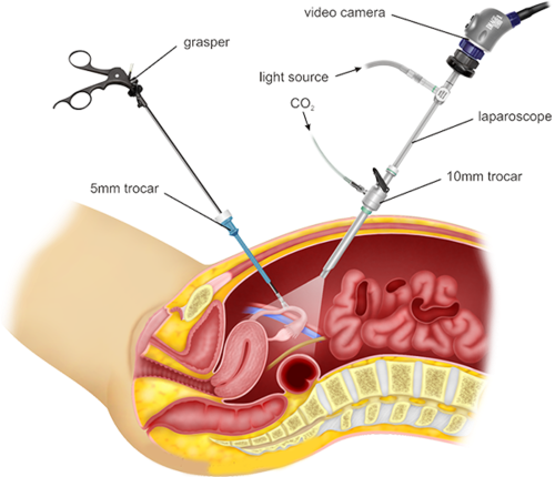 Laparoscopic Surgery Cost in Indore | Dr. Nikunj Jain | Apollo Hospital 2 Laparoscopic Surgery Cost in Indore