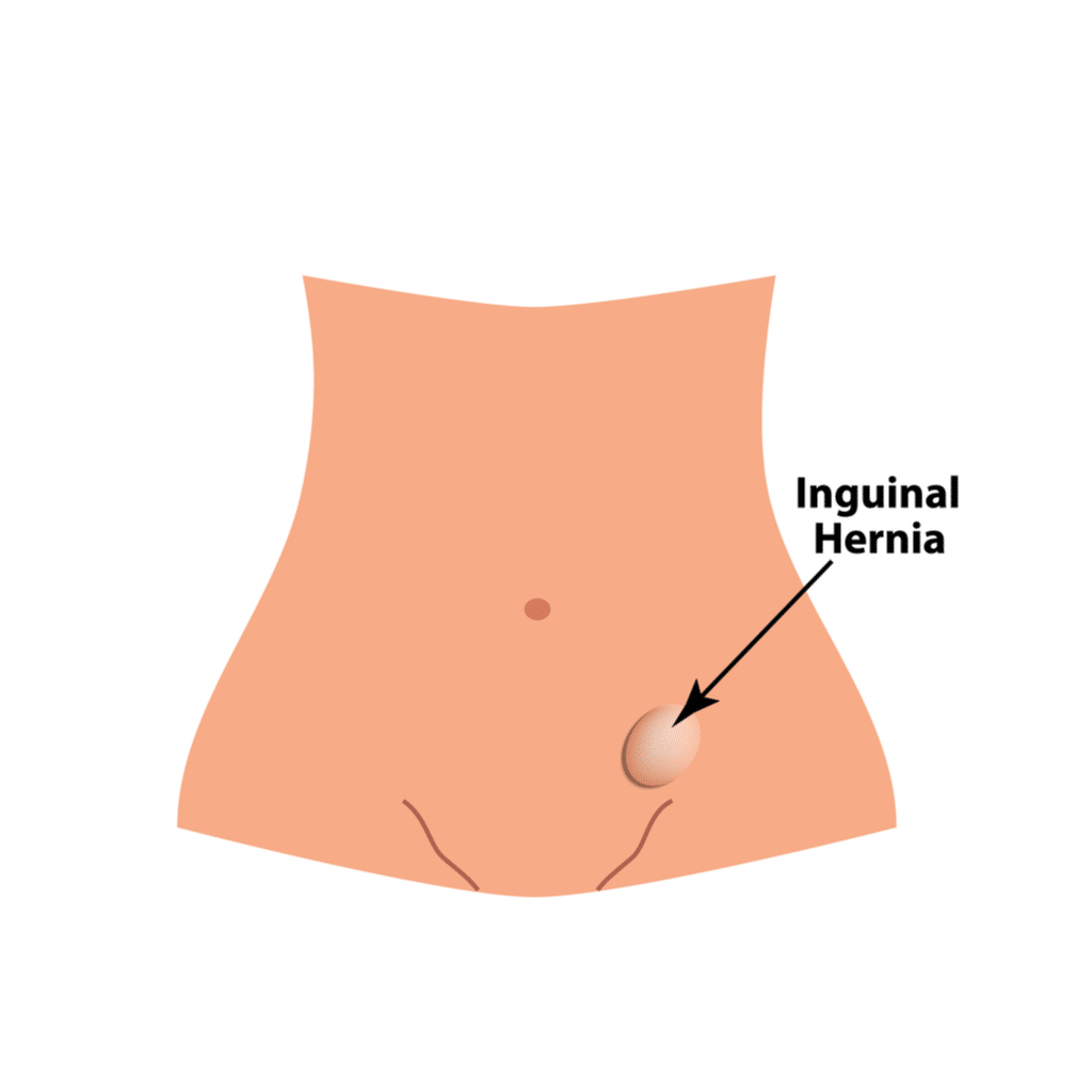 Best Hernia Surgeon in Indore | Dr. Nikunj Jain | Apollo Hospital 3 Best Hernia Surgeon in Indore