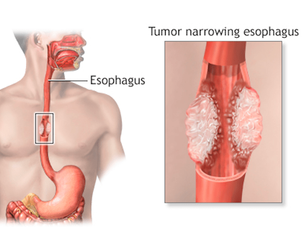 Esophageal Surgery in Indore | Dr. Nikunj Jain | Apollo Hospital 1 Esophageal Surgery in Indore