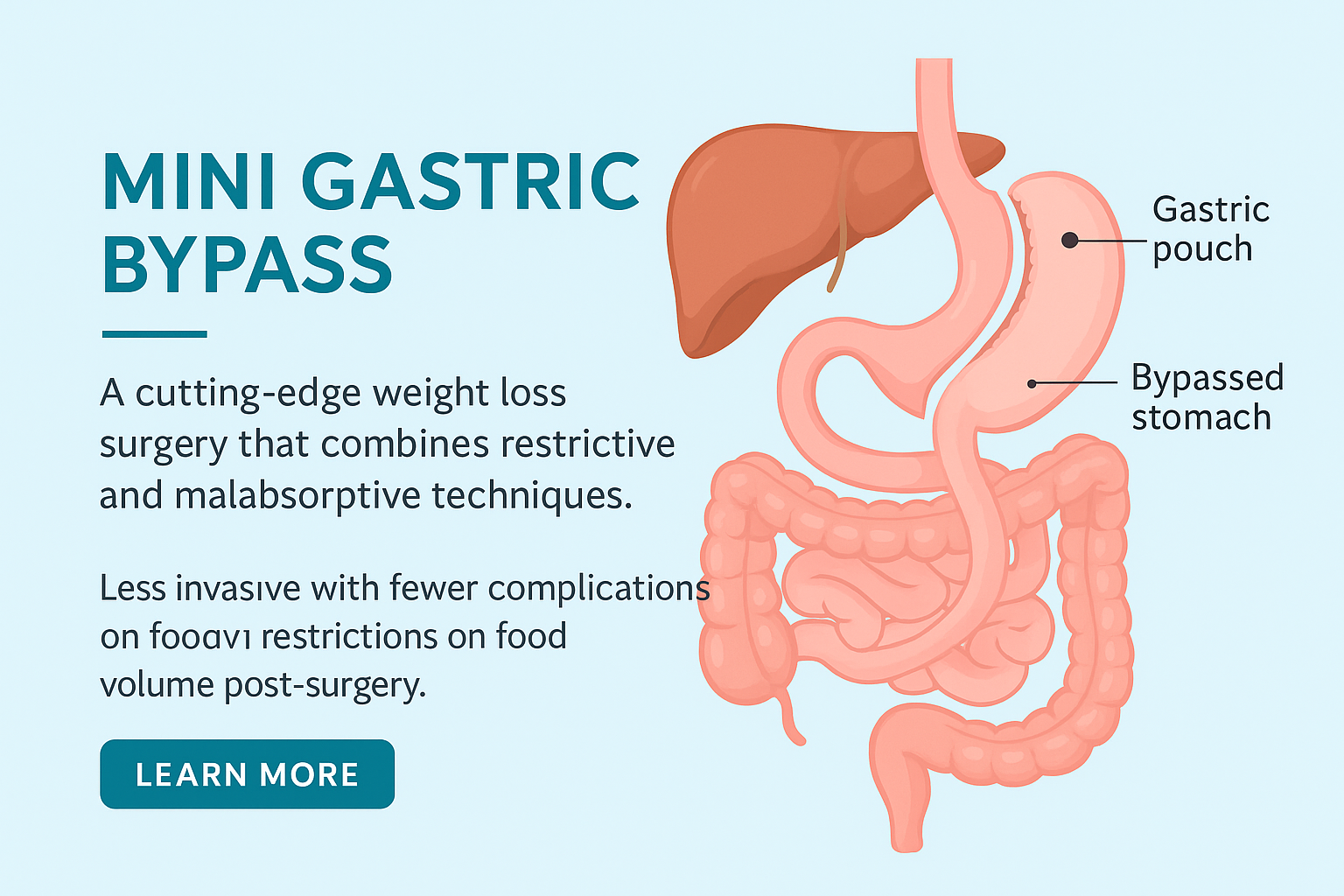 Mini Gastric Bypass (MGB) in Indore 1 image 3