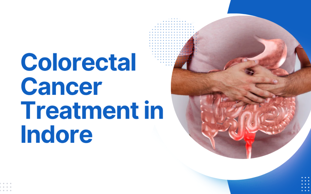 Colorectal Cancer Treatment in Indore | Top Oncologists, Diagnosis & Stages
