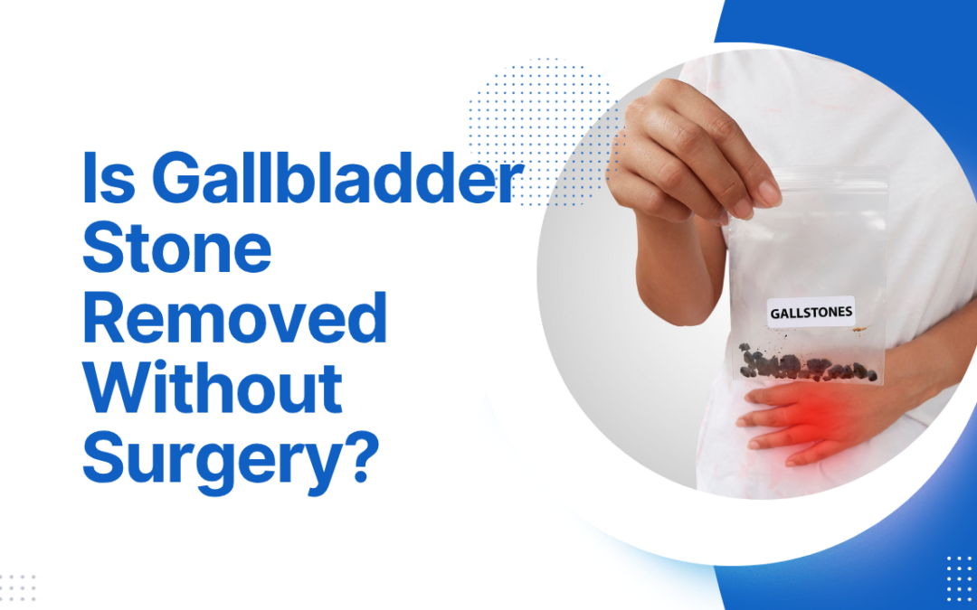 Is Gallbladder Stone Removed Without Surgery?