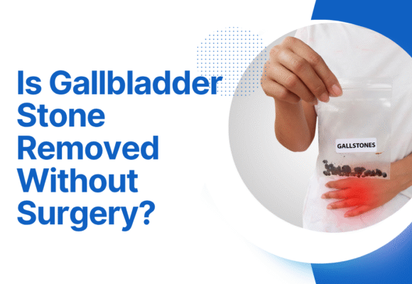 Is Gallbladder Stone Removed Without Surgery?