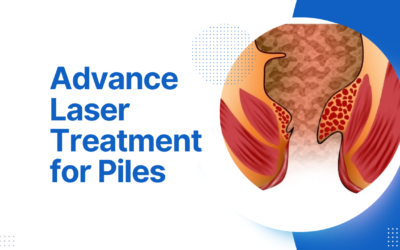 Blogs Advance Laser Treatment for Piles, Fissure, and Fistula: A Complete Guide to Pain-Free Recovery