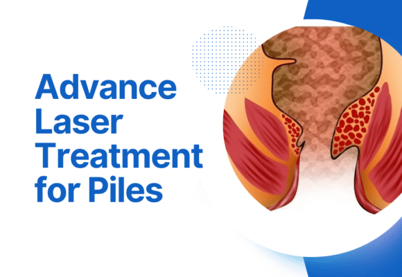 advance laser treatment for piles