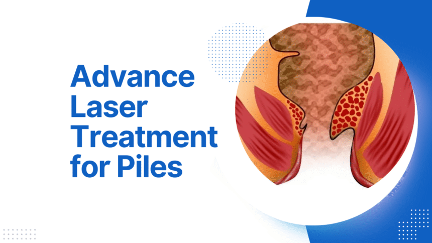 advance laser treatment for piles