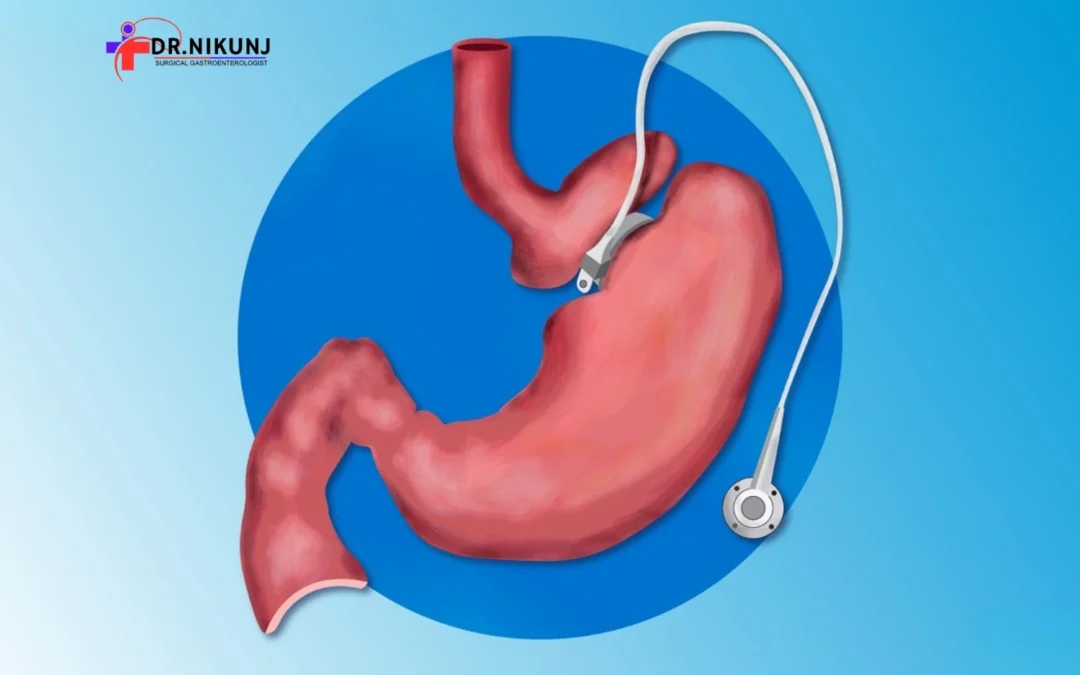 Affordable Laparoscopic Treatment in Indore for Gastro Problems