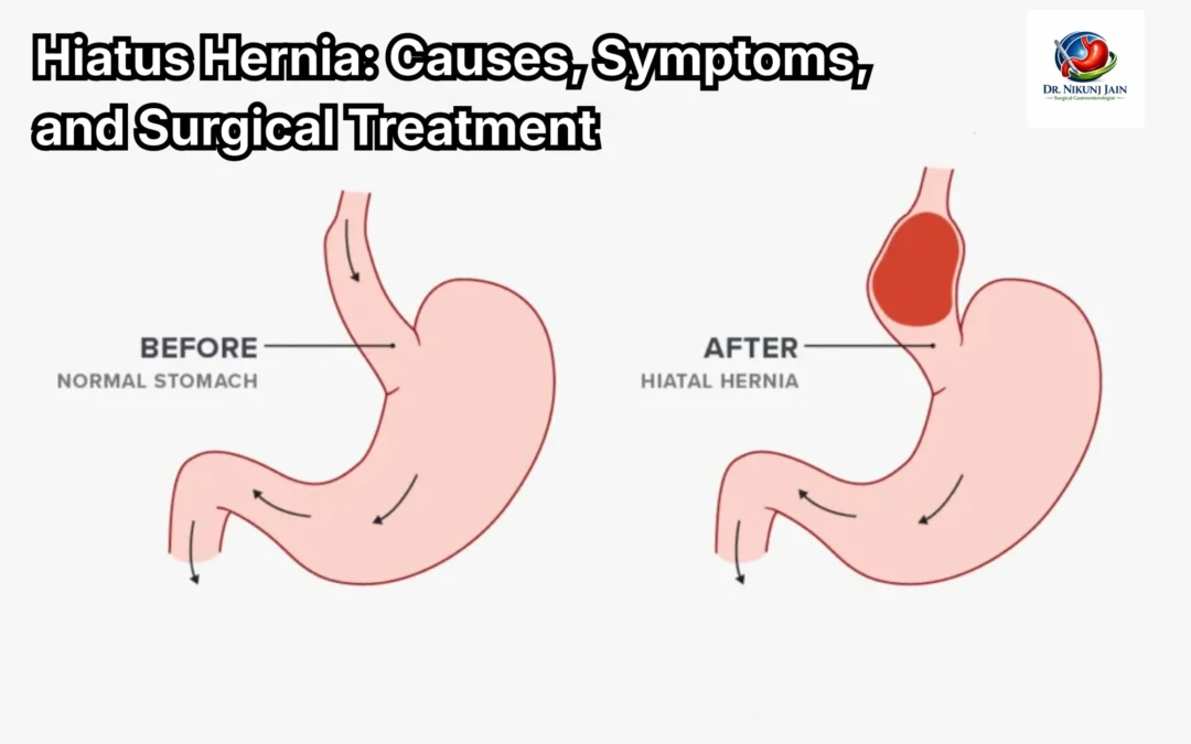 hiatus hernia treatment, hiatus hernia surgery, hiatus hernia surgeon, laparoscopic hiatus hernia surgery, acid reflux treatment, GERD surgery, heartburn treatment, hiatal hernia repair, sliding hiatus hernia, paraesophageal hernia, stomach hernia treatment, reflux surgery, fundoplication surgery, gastro surgeon, minimally invasive hernia surgery, chronic acidity treatment, food pipe reflux, esophagus hernia, surgical treatment for GERD, best hiatus hernia doctor, hiatus hernia specialist, advanced hernia surgery, long term reflux relief, digestive surgery specialist, Dr Nikunj Jain