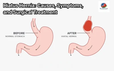 Blogs Hiatus Hernia: Causes, Symptoms, and Surgical Treatment