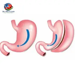 Life After Sleeve Gastrectomy A Month by Month Guide Dr. Nikunj Jain Best Weight Loss Doctor In Indore