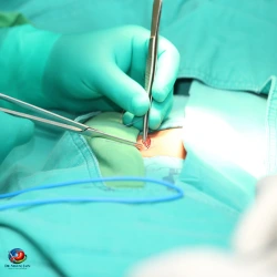 Is Hernia Surgery Painful 2 1