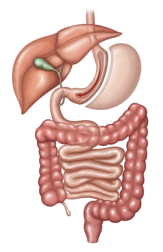 Sleeve Gastrectomy, Sleeve Gastrectomy in Indore, Weight Loss Surgery, Bariatric Surgery, Bariatric Surgeon in Indore, Dr. Nikunj Jain, Weight Loss Treatment, Obesity Treatment, Gastric Sleeve Surgery, Laparoscopic Sleeve Gastrectomy, Best Bariatric Surgeon in Indore, Weight Loss Doctor in Indore, Obesity Surgery, Surgical Weight Loss, Fat Loss Surgery, Advanced Bariatric Surgery, Minimally Invasive Weight Loss Surgery, Weight Management Treatment, BMI Reduction Surgery, Diabetes and Weight Loss Surgery, Bariatric Clinic in Indore, Treatment for Obesity, Metabolic Surgery, Safe Weight Loss Surgery, Gastric Sleeve Procedure