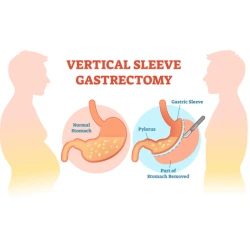 Expert Sleeve Gastrectomy in Indore for Effective Weight Loss 2 1