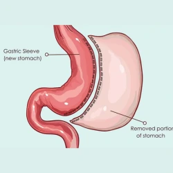 Expert Sleeve Gastrectomy in Indore for Effective Weight Loss