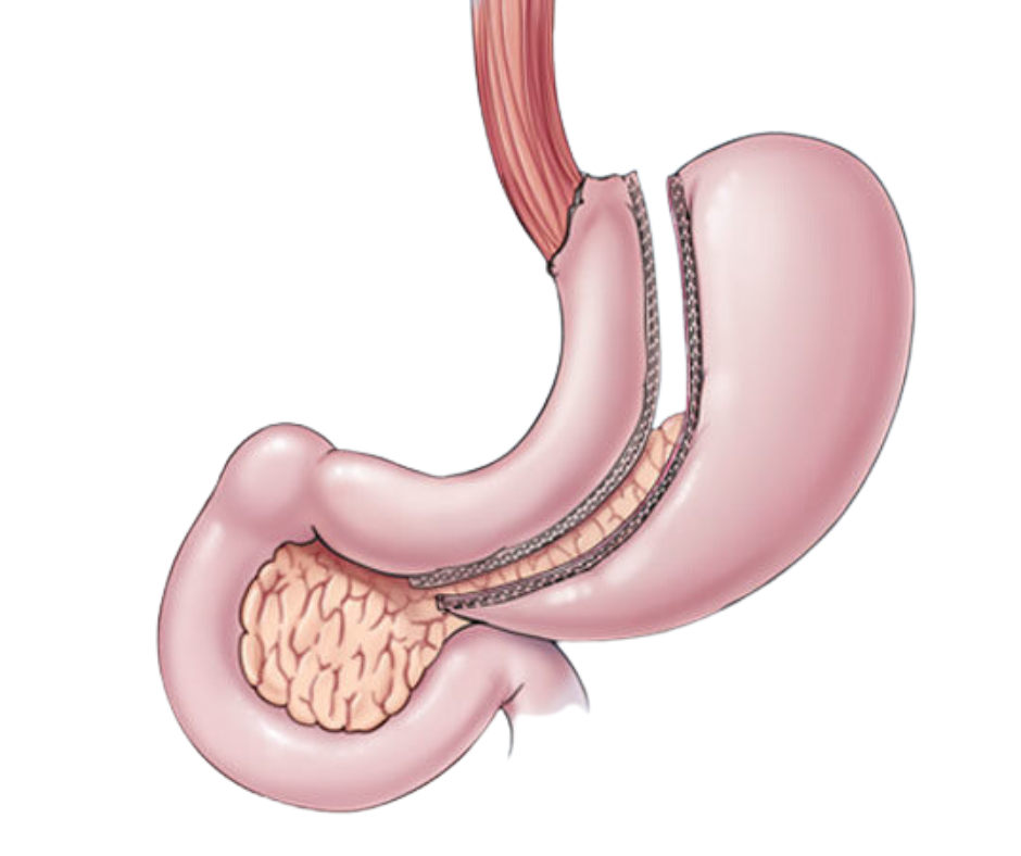 MetabolicSurgery, DrNikunjJain, MetabolicSurgeryIndore, WeightLossSurgery, BariatricSurgery, DiabetesSurgery, ObesityTreatment, HealthyWeightLoss, AdvancedLaparoscopy, GastroSurgeon, BestBariatricSurgeon, WeightLossJourney, Type2DiabetesCare, ObesityCare, LaparoscopicSurgery, MinimallyInvasiveSurgery, GastricBypass, SleeveGastrectomy, HealthTransformation, WeightManagement, IndoreDoctor, FitnessAndHealth, MetabolicHealth, DigestiveHealth, BariatricCareIndore