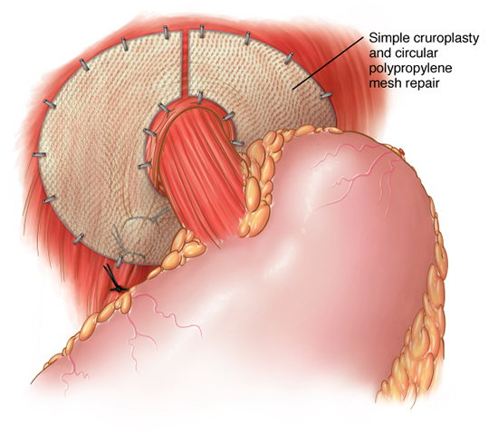 mesh surgery for hernia, Dr. Nikunj Jain, best hernia doctor in Indore, best laparoscopic surgeon in Indore, hernia treatment in Indore, piles treatment in Indore, piles doctor in Indore, best piles doctor in Indore, gastroenterologist in Indore, weight loss clinic in Indore, weight loss doctor in Indore, best weight loss doctor in Indore, best bariatric surgeon in Indore, bariatric doctor in Indore, best weight loss surgeon in Indore

