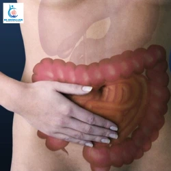 Appendicitis Surgery Laparoscopic vs Open 2