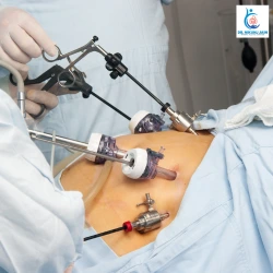 When Do You Need Laparoscopic Surgery