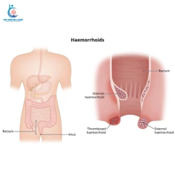 Laser Piles Treatment vs Traditional Surgery Which Heals Faster 2