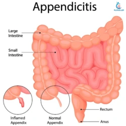 Appendicitis Symptoms: Signs of a Medical Emergency Appendicitis Symptoms Signs of a Medical Emergency