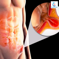 Hernia Surgery Cost in Indore What Really Affects the Price￼