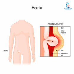 Can You Exercise Walk or Go to the Gym With a Hernia